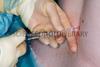 Epidural injection