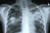 Chest xray with TB